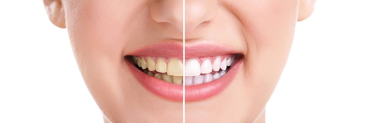 Teeth Whitening